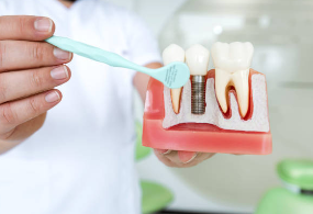 Cost of Dental Implants