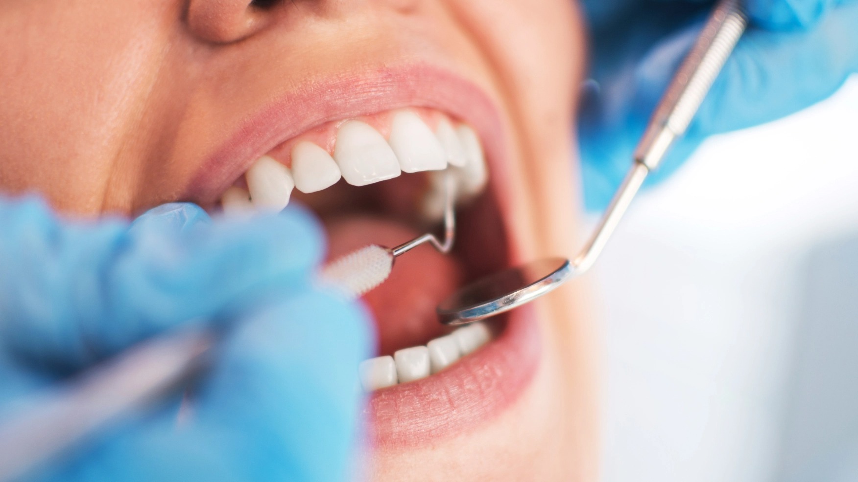 Maintaining Dental Fillings