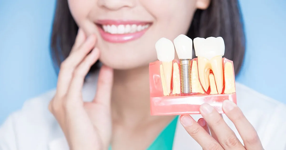 Dental Implants in Melbourne