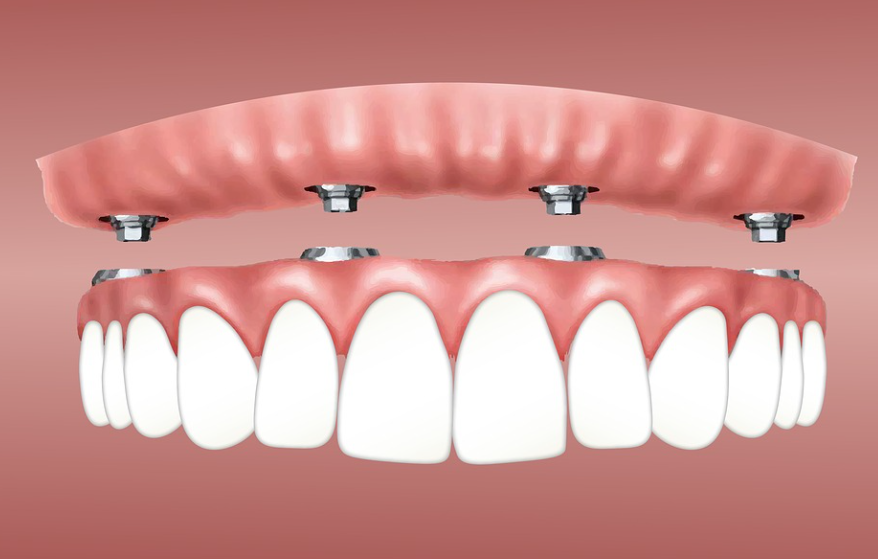 Dental Implants